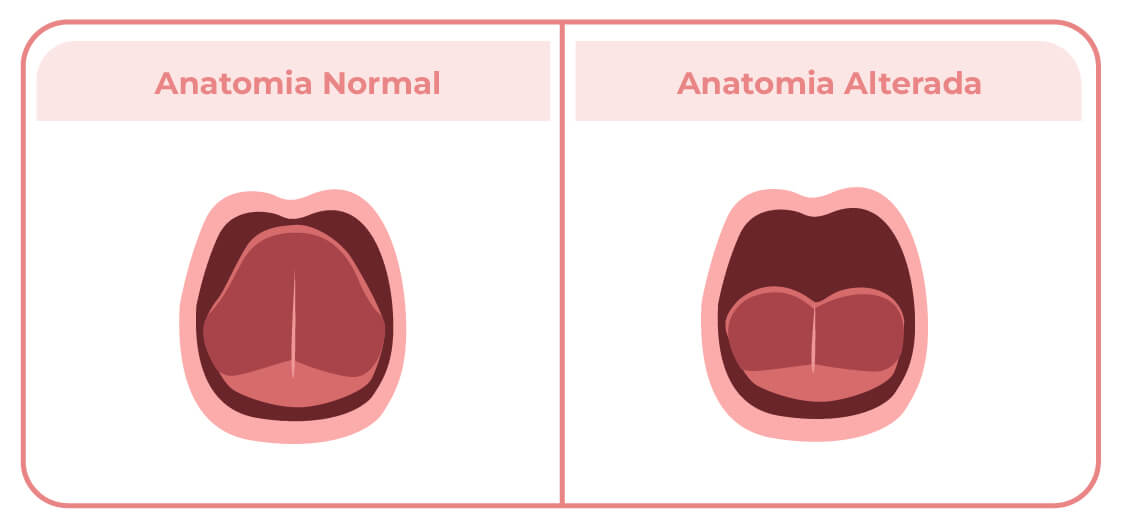 Comparación entre un frenillo normal y uno corto | Bebés | San Pablo Farmacia