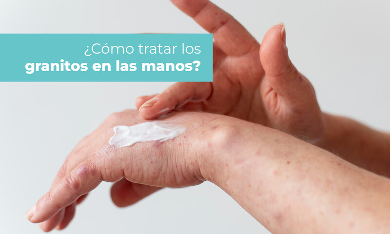 como-tratar-los-granitos-en-las-manos