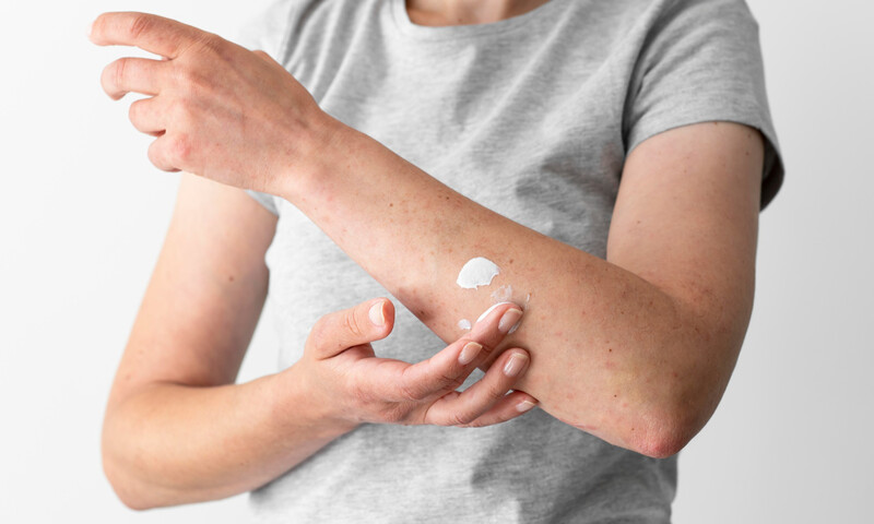 dermatitis-atopica-cuida-tu-piel