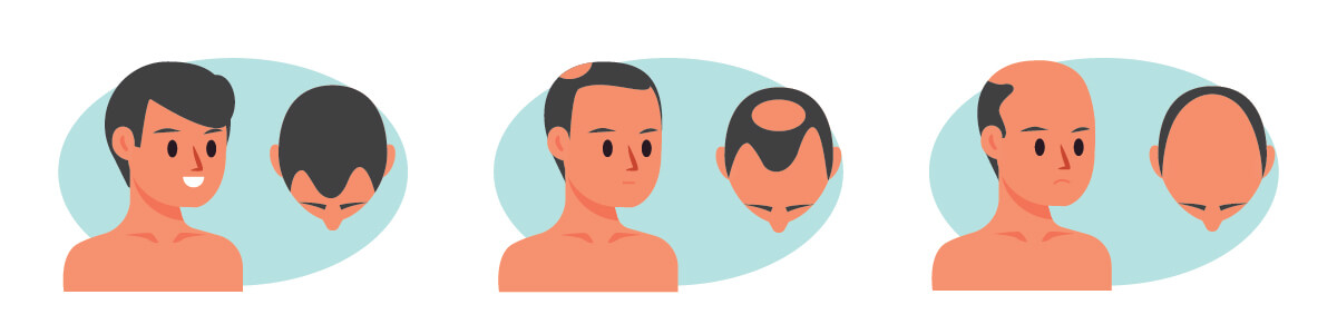 Esquema de alopecia en hombres | Dermocosméticos | San Pablo Farmacia
