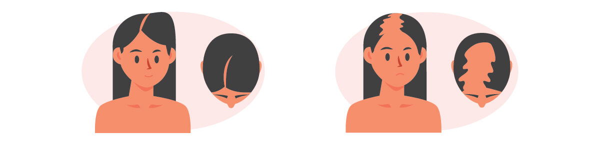 Esquema de alopecia en mujeres | Dermocosméticos | San Pablo Farmacia
