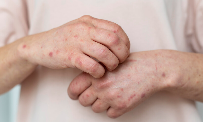 Granos en las manos: Causas y tratamiento | Dermocosméticos | San Pablo Farmacia