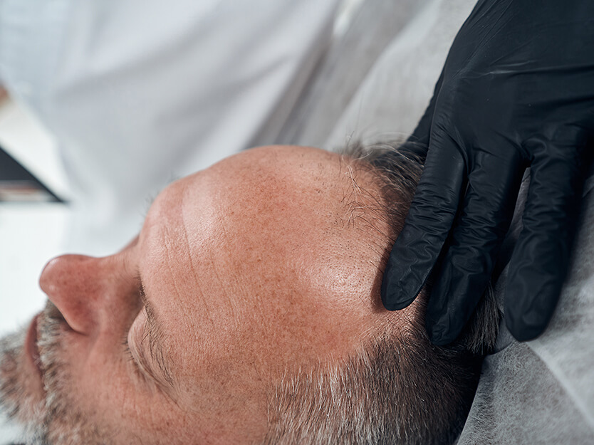 Acude al dermatólogo | Alopecia androgénica | Dermocosméticos | San Pablo Farmacia