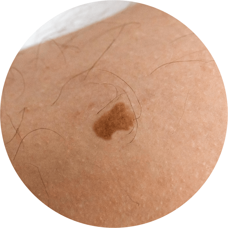 Melanoma asimétrico | Dermocosméticos | San Pablo Farmacia