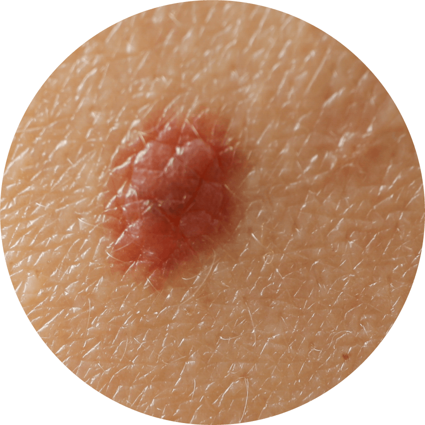 Melanoma con bordes irregulares | Dermocosméticos | San Pablo Farmacia