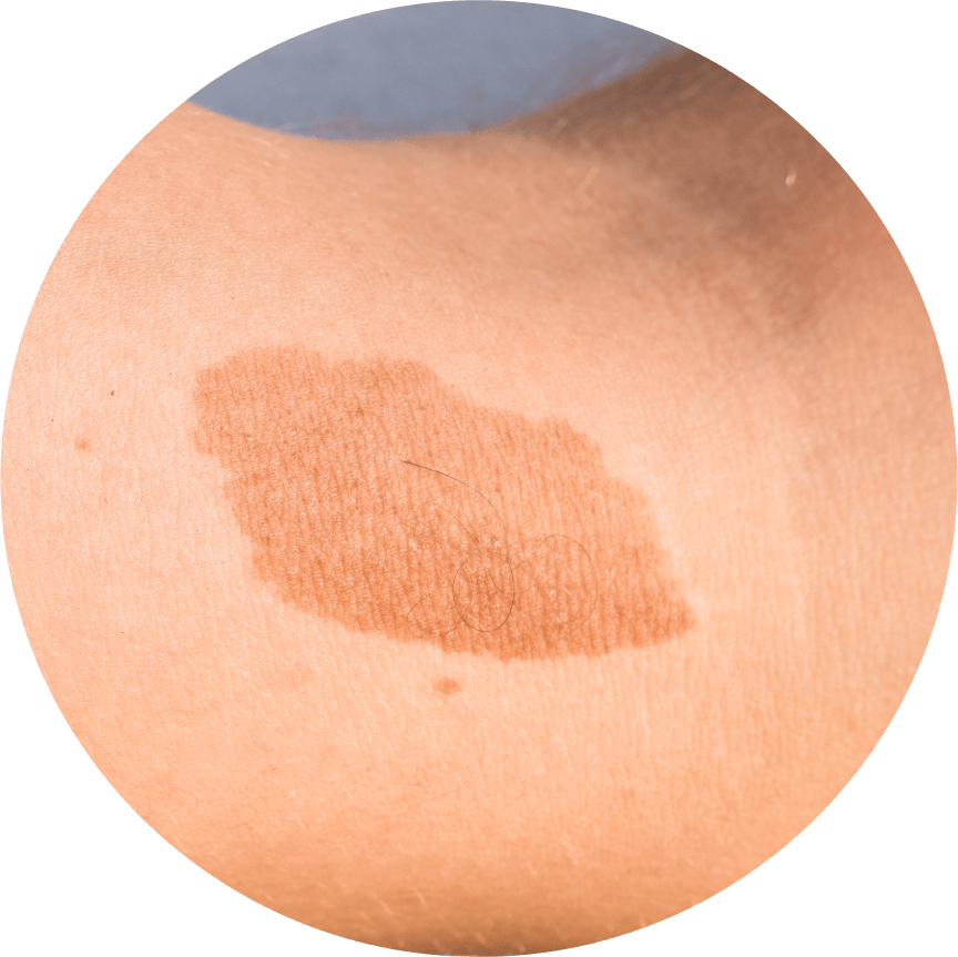Tamaño del melanoma | Dermocosméticos | San Pablo Farmacia