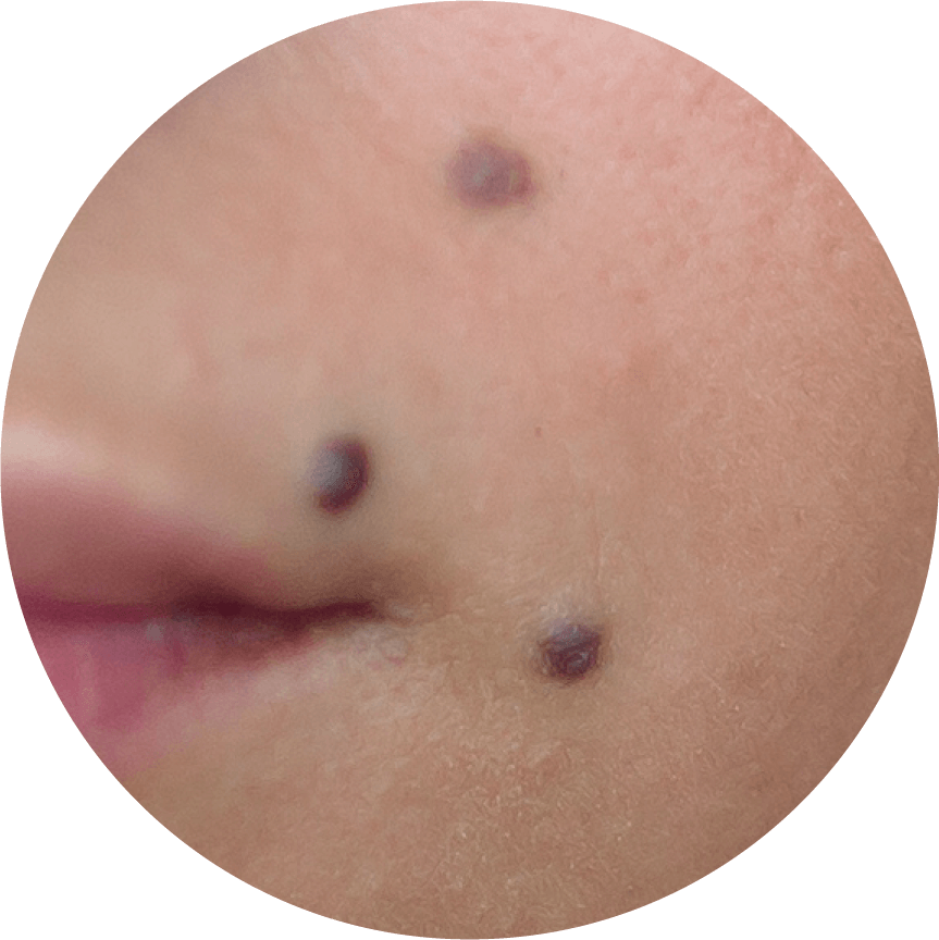Evolución del melanoma | Dermocosméticos | San Pablo Farmacia