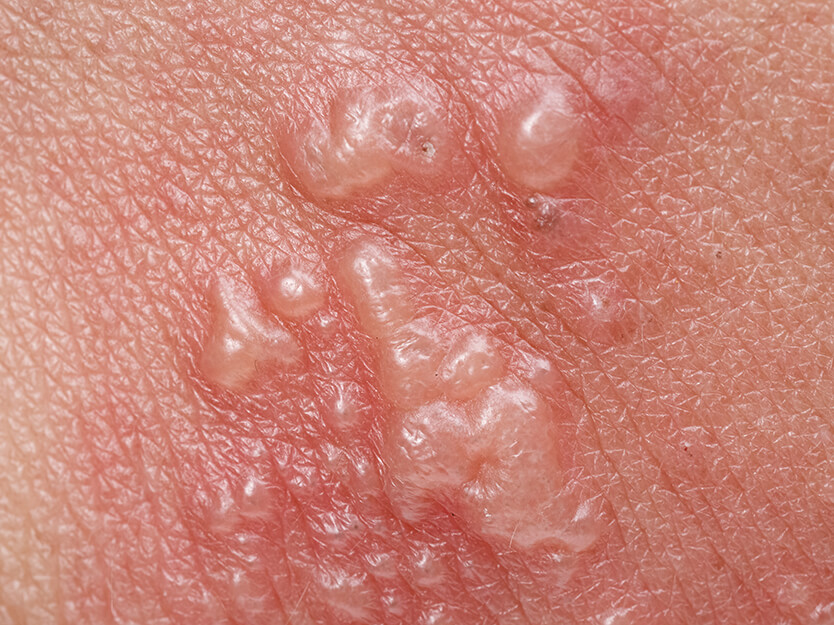 Eritema | Exantema, erupción o sarpullido | Dermocosméticos | San Pablo Farmacia