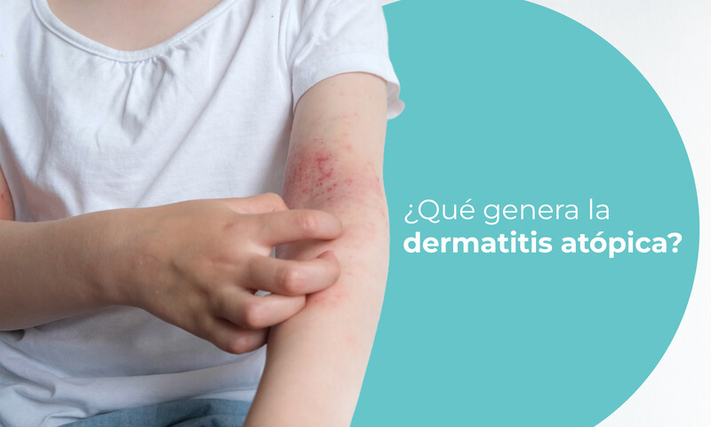 que-genera-la-dermatitis-atopica