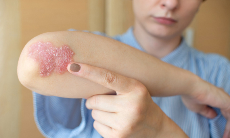 ¿Qué es la psoriasis y cómo tratarla naturalmente?