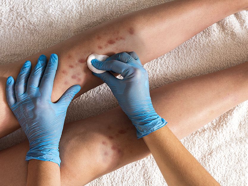 Dermopatía diabética | SPF | San Pablo Farmacia