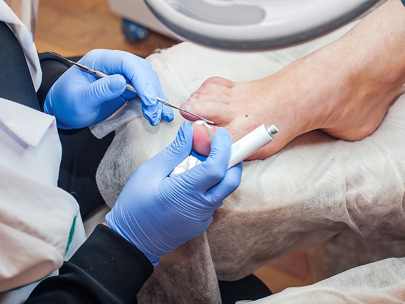 Bullosis diabeticorum | SPF | San Pablo Farmacia