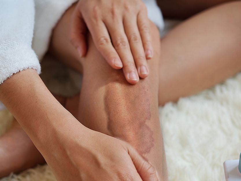 Necrobiosis lipoídica | SPF | San Pablo Farmacia